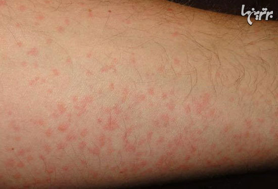 حساسیت‌های عجیب به مواد غیرخوراکی