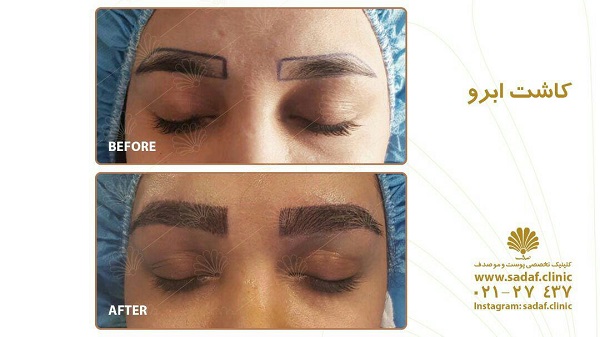 کاشت ابرو؛ عوارض و هزینه آن