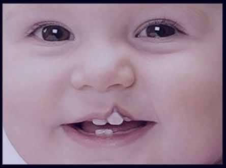 دلایل ابتلاء به یکی از شایع‌ترین بیماری‌های مادرزادی سر و گردن