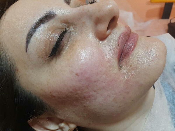 جوانسازی صورت در یک جلسه