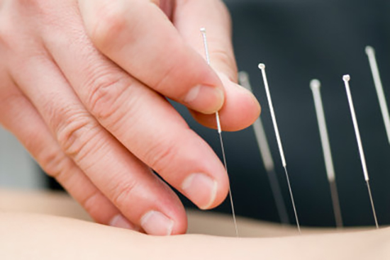 طب سوزنی و هرآنچه باید بدانید