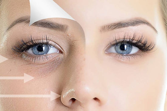 فیلر زیر چشم، رفع گودی و سیاهی زیر چشم