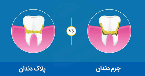 روش‌های سنتی جِرم‌گیریِ دندان در خانه