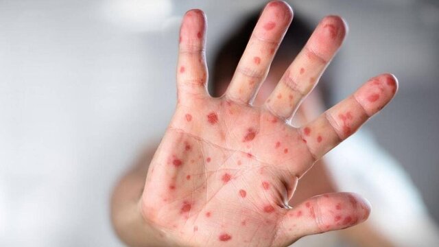 شباهت علائم آبله میمونی و آبله مرغان / نحوه نمونه گیری از افراد مشکوک به بیماری